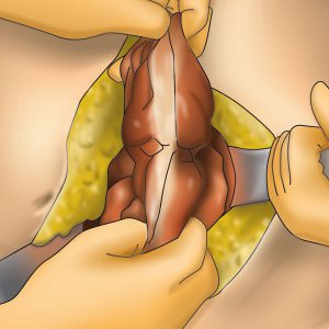 surgery-examination-colon