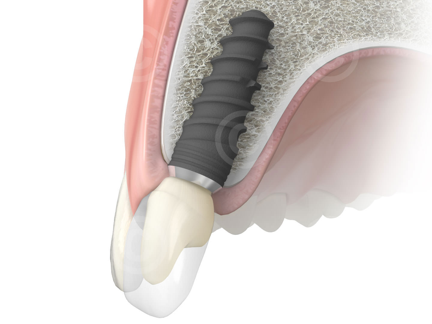 Dental implants for implantological manual