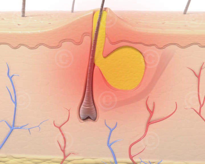 Aknepickel und Entzuendung grafik acne pimples and inflammation