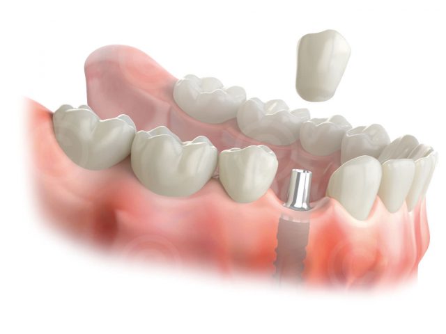 Screw-retained abutmen