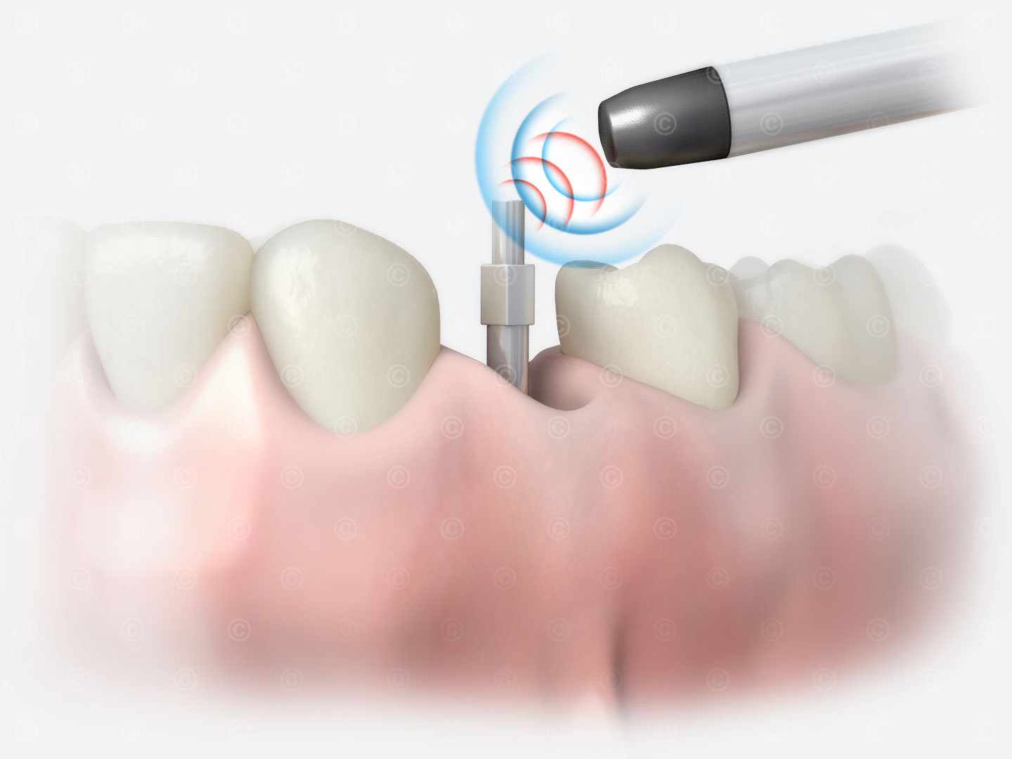 Stability test of a dental implant