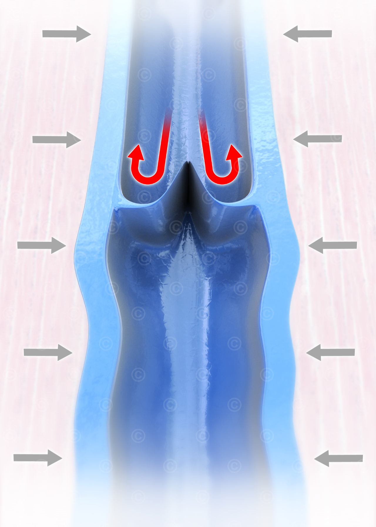 Illustration der Wirkung einer Kompressionstherapie bei Venenklappeninsuffizienz kompressionstherapie venenklappeninsuffizienz