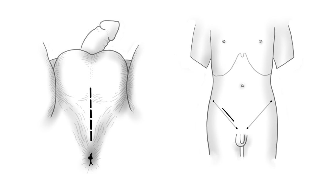 Sections Testicular surgery