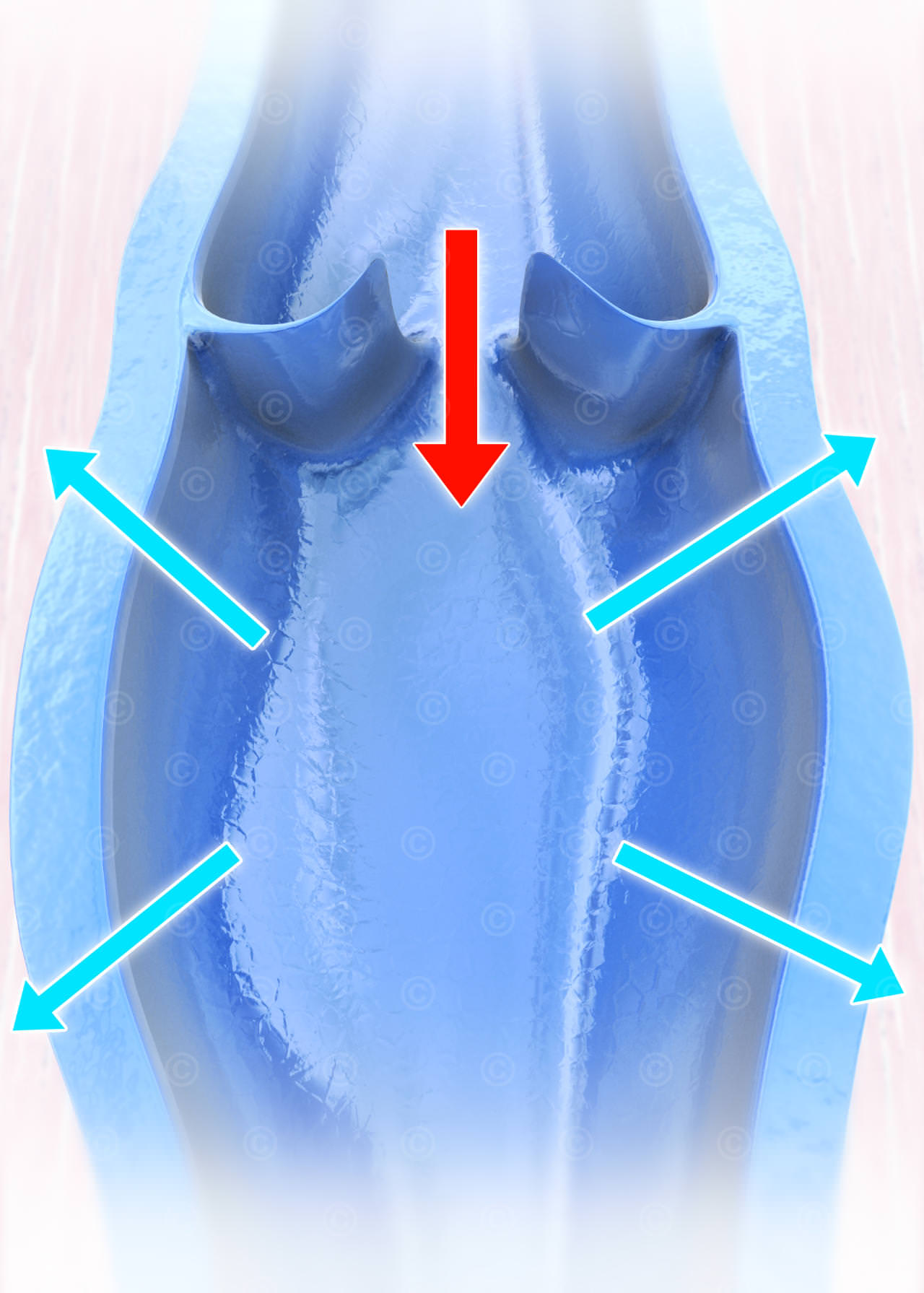 Illustration einer Venenklappeninsuffizienz venenklappeninsuffizienz