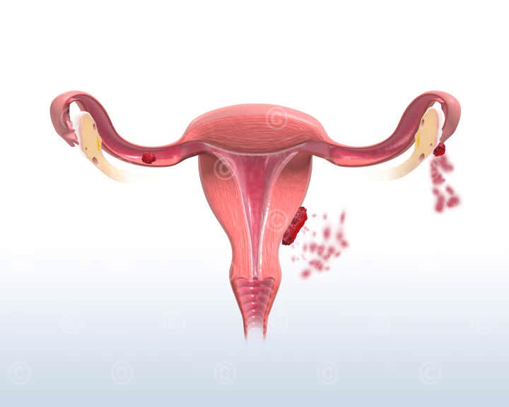 endometriose monatsblutung