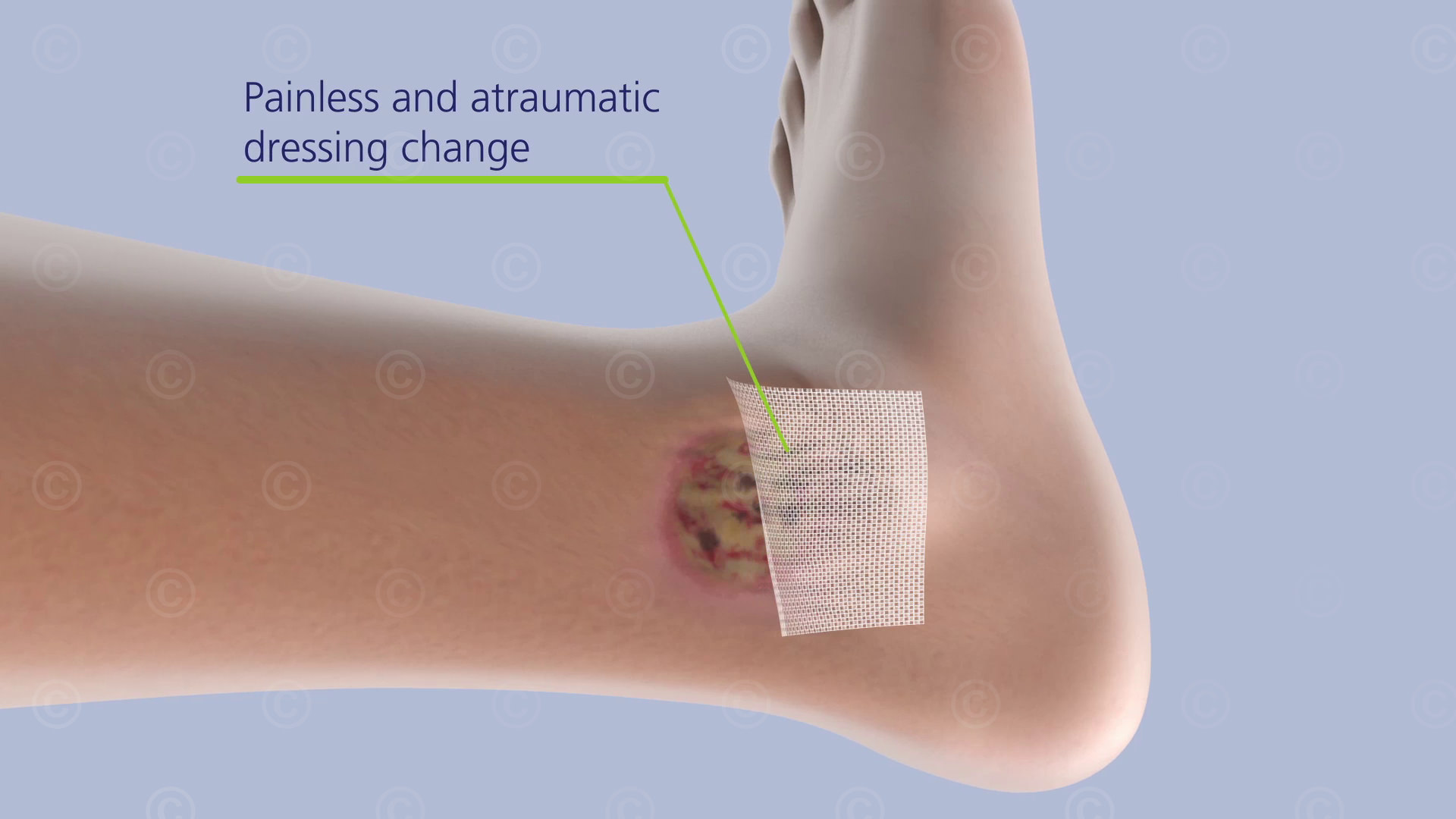 Painless removal of the Atrauman wound dressing