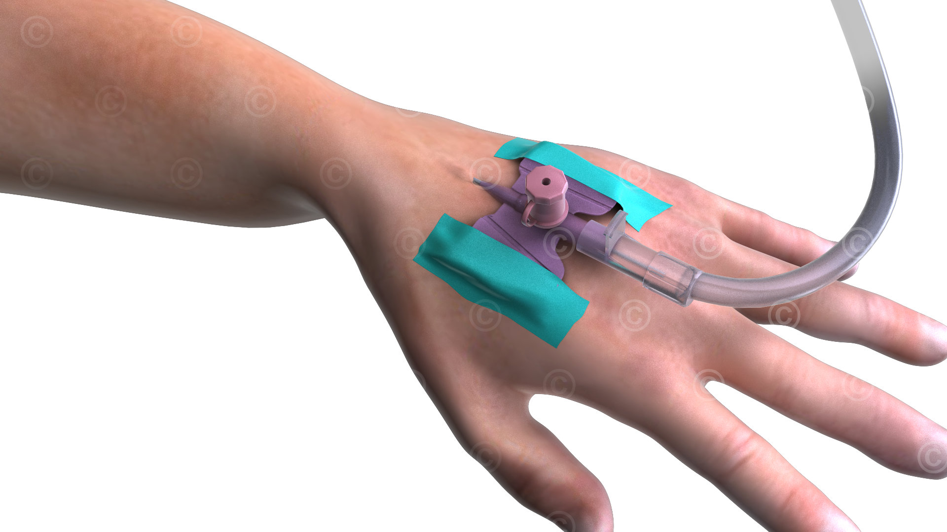 infusion hand