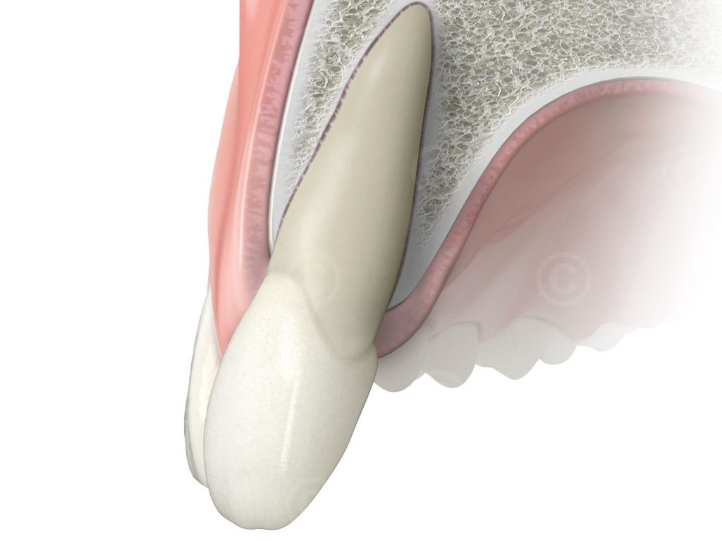 Upper jaw with incisor