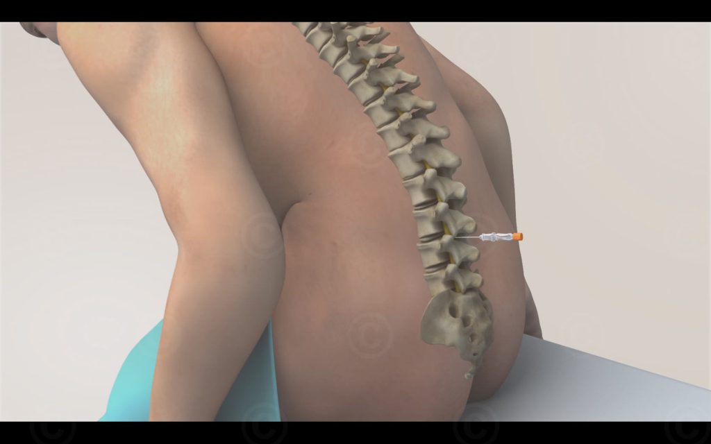 Spinalanästhesie