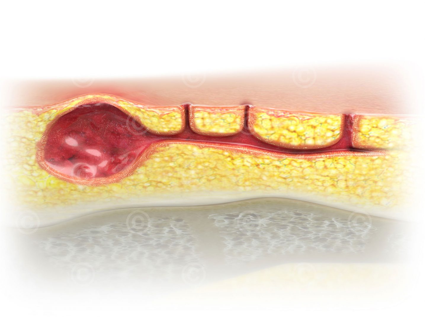 Anatomische Darstellung Einer Stei beinfistel MedicalGraphics Anatomische Darstellung Einer Stei beinfistel MedicalGraphics