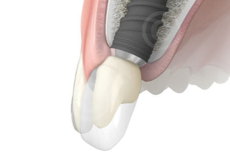 dental-implant-maxilla