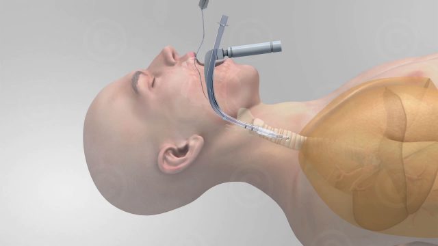 Medical animation "Explanatory movie anesthesia"