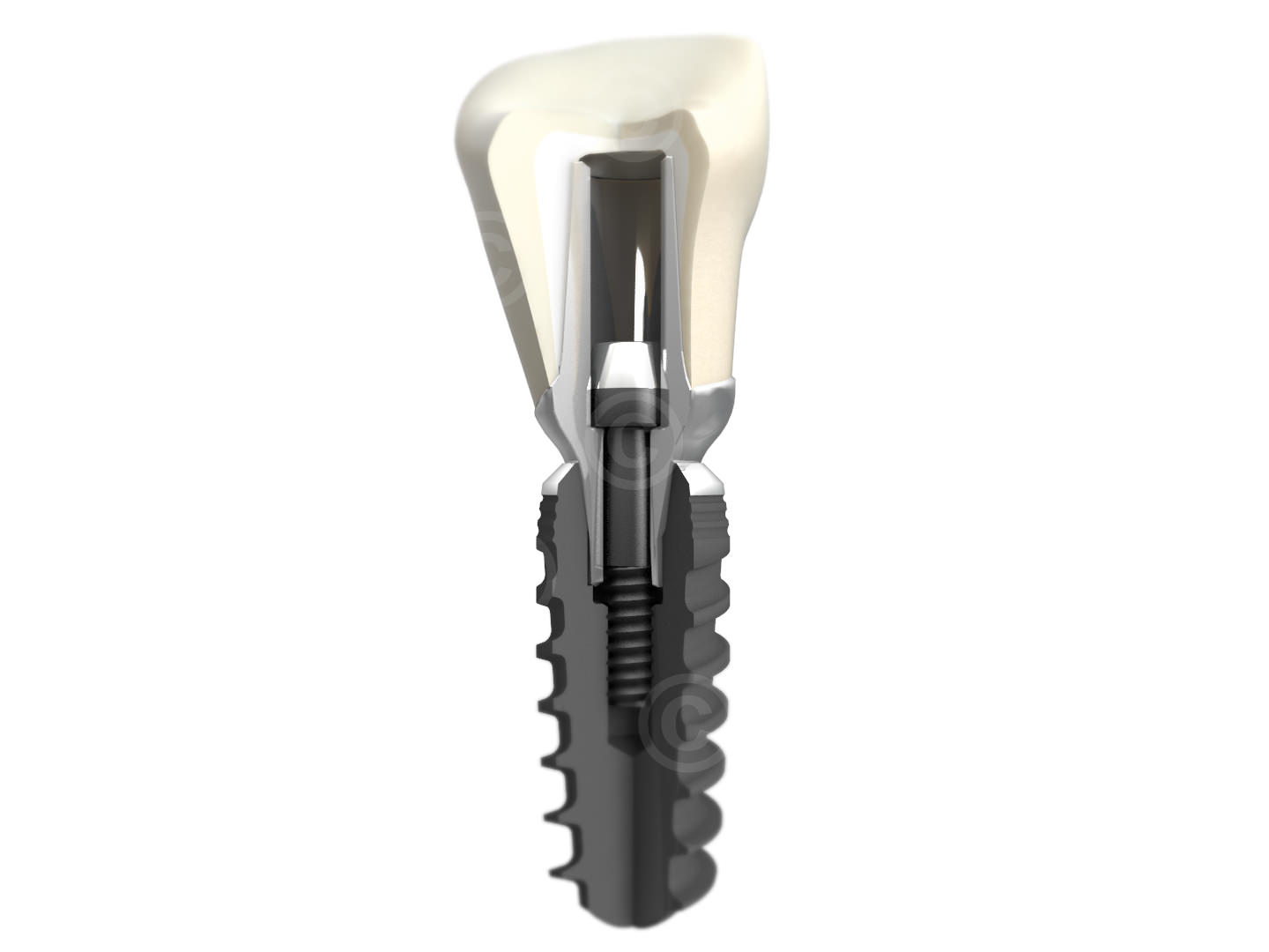 aufbau dental implantat aufbau dental implantat gross