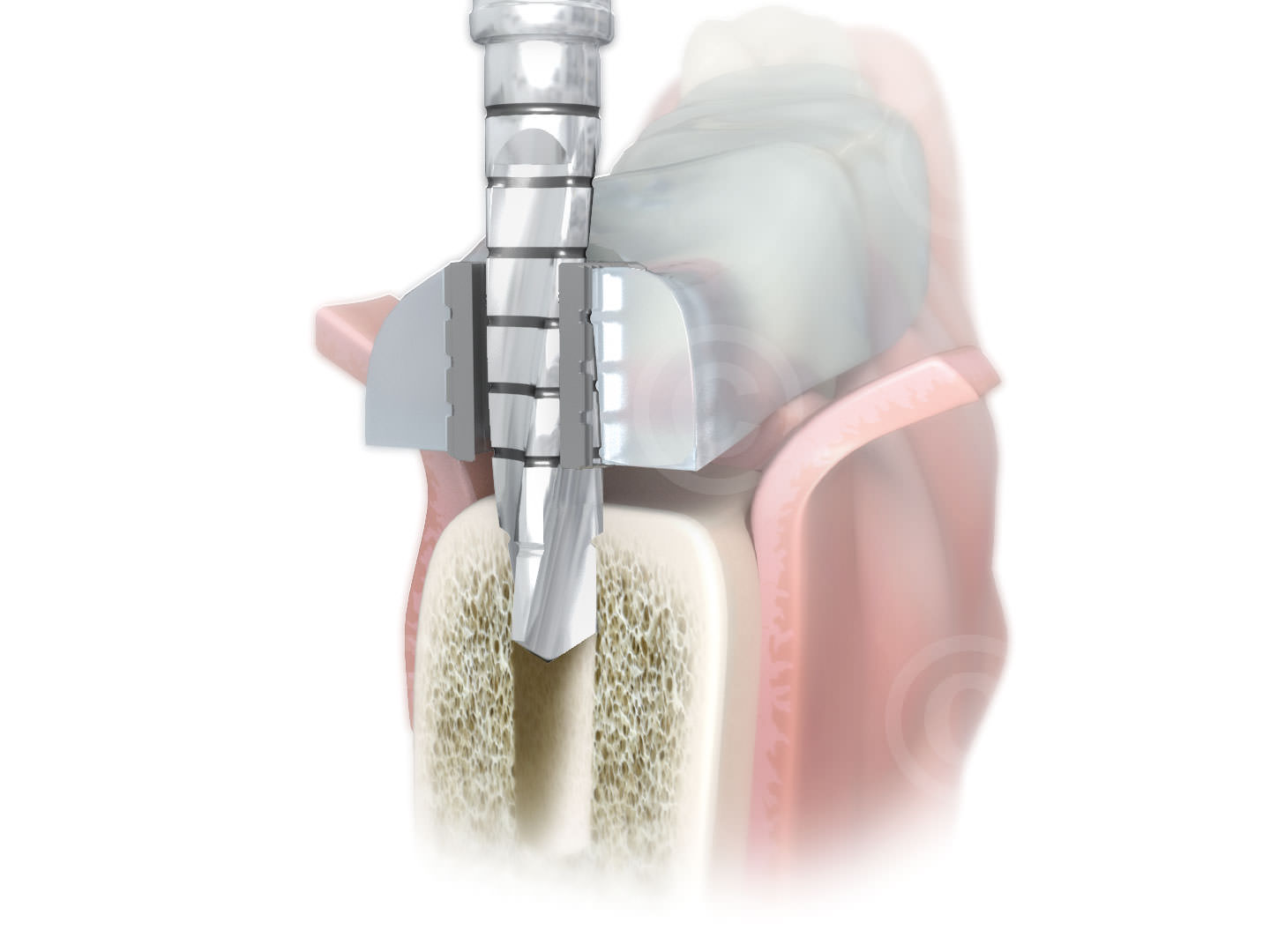 computer guided surgery dental implantat gross