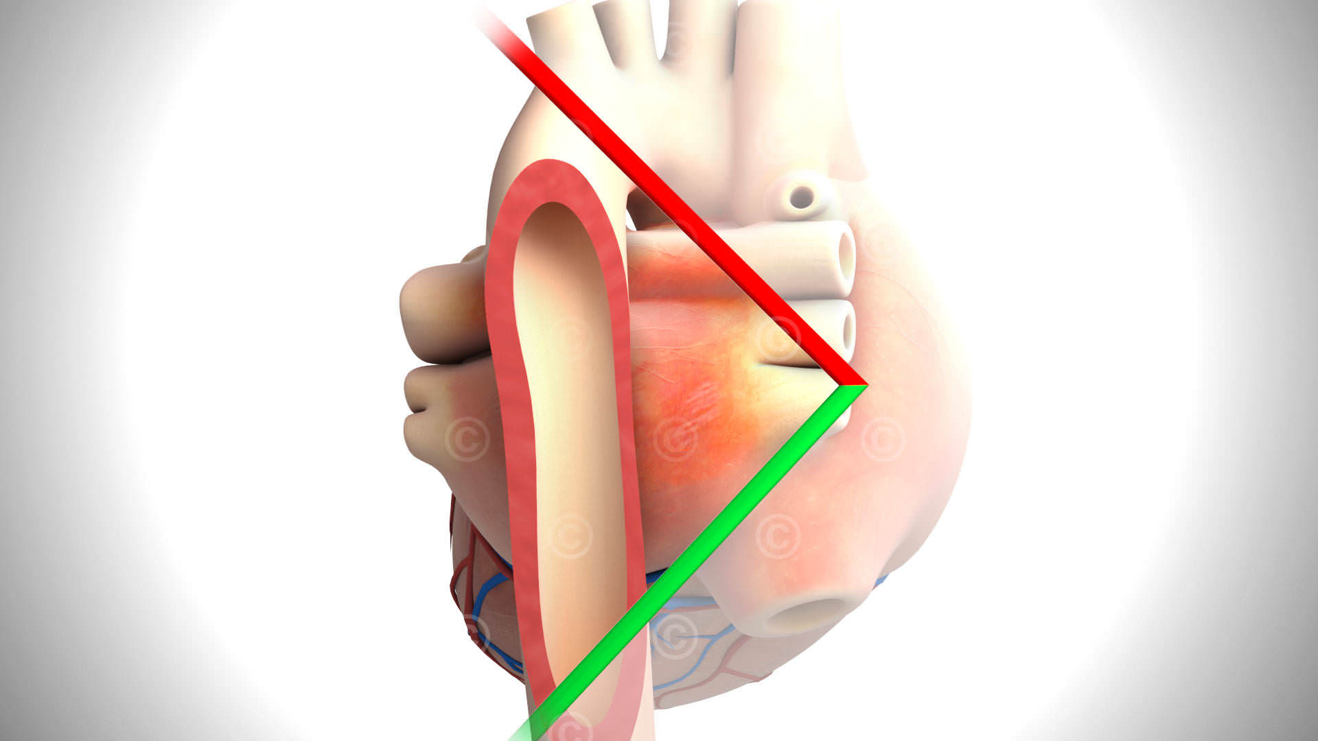 Transesophageal Echocardiography - Descending Aorta LAX View TEE Descending Aorta LAX View