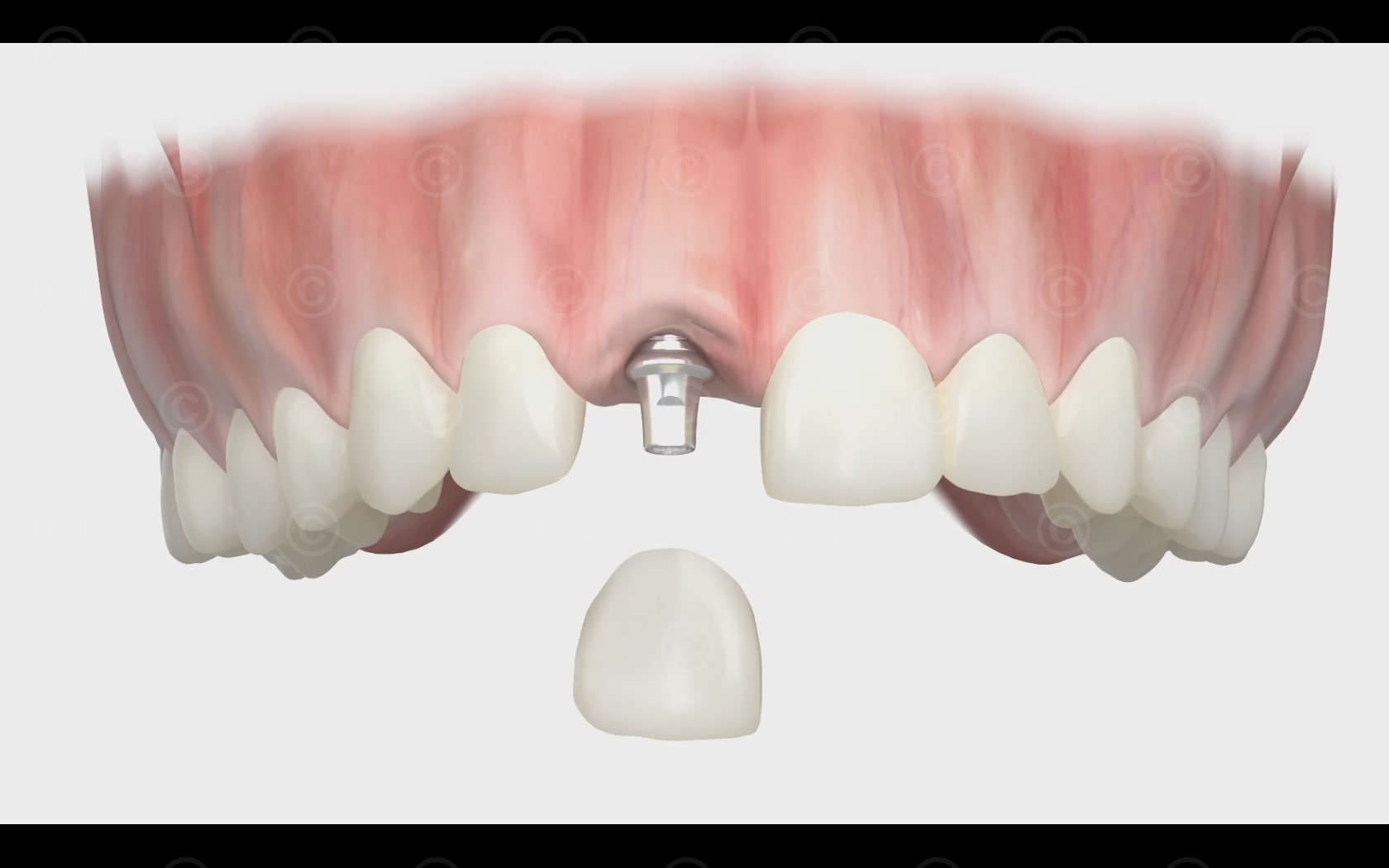 dentale-Implantologie