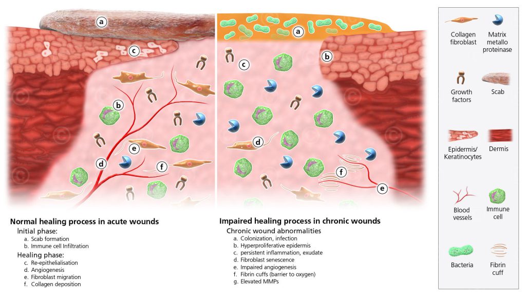 Illustration of chronic wound compared to the acute wound MedicalGraphics