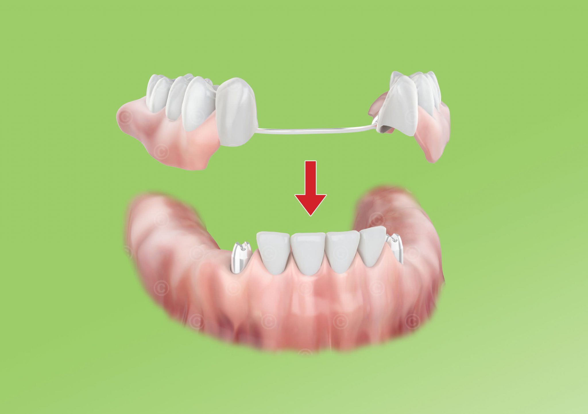 Illustrations dental prosthesis MedicalGraphics