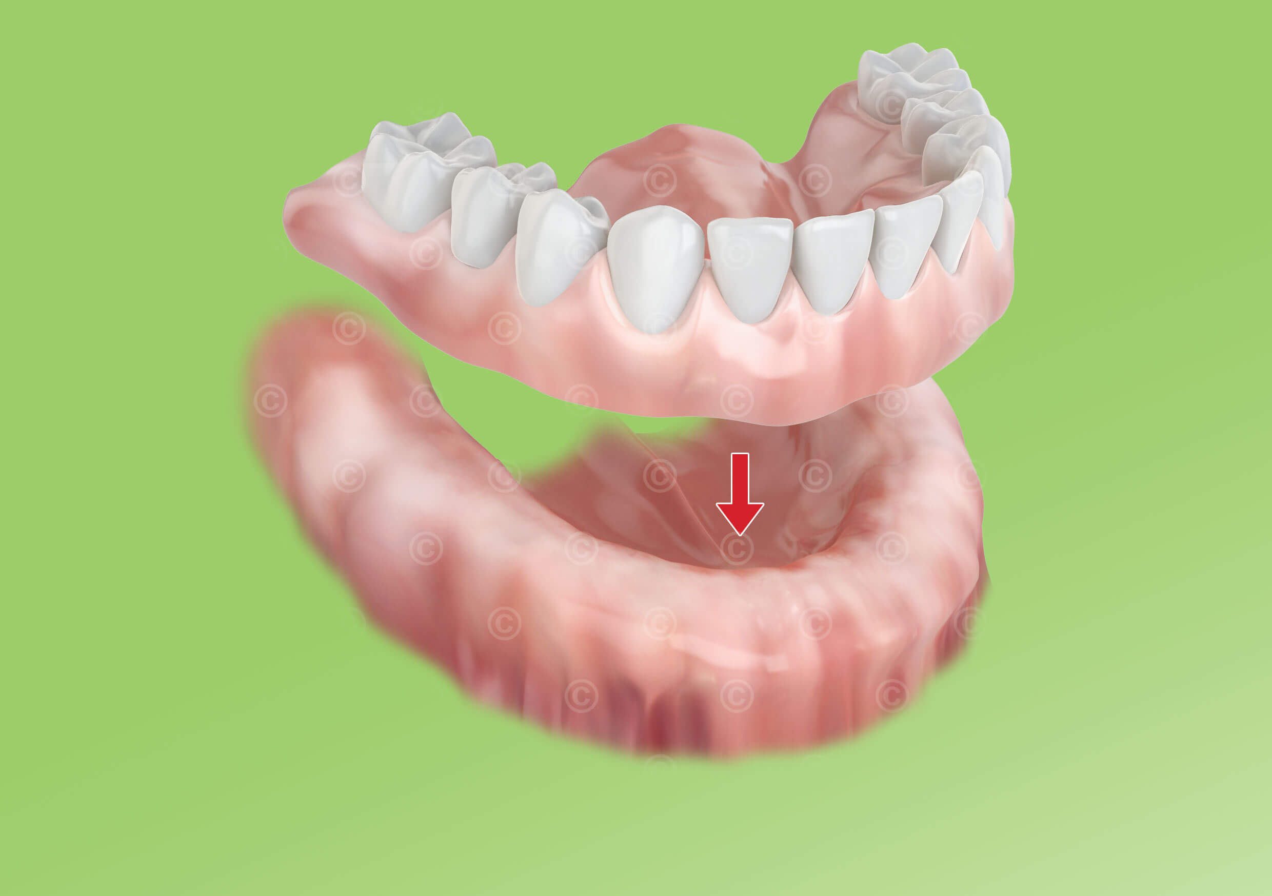 Dentale Vollprothese am Unterkiefer Full dental prosthesis lower jaw