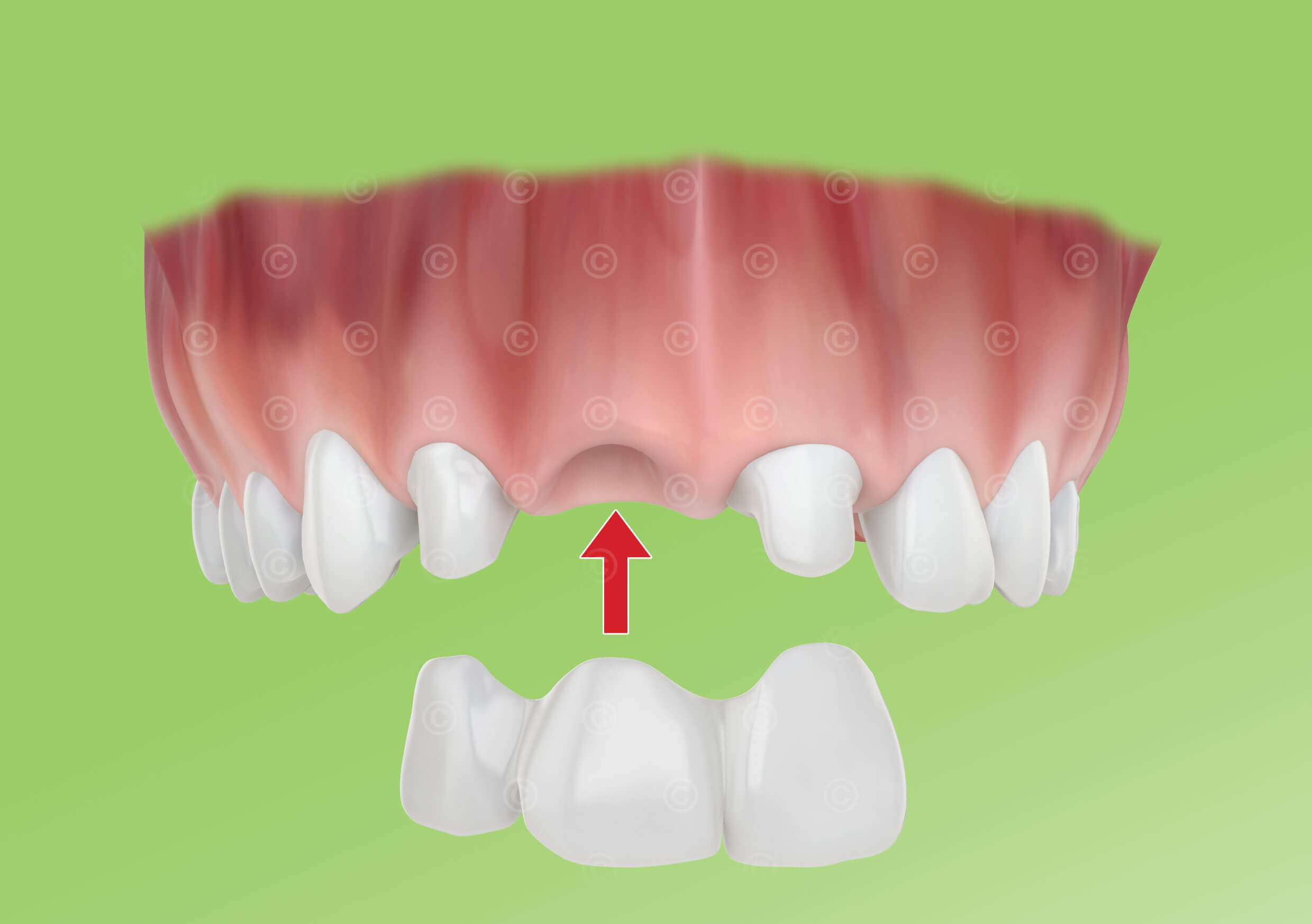 Dental bridge