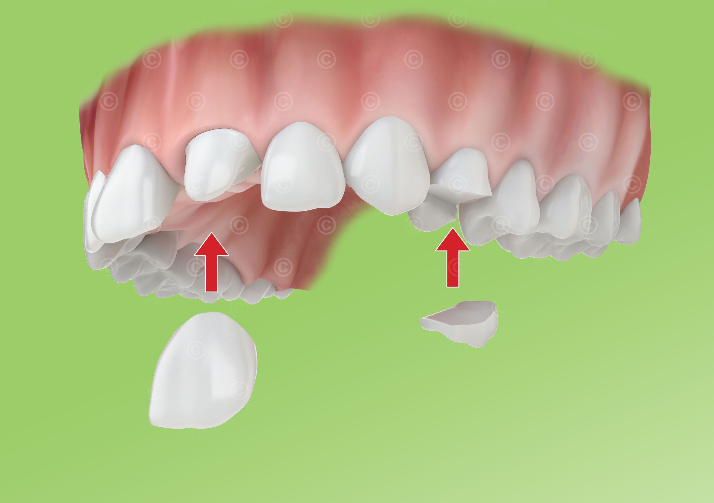 Dental crown