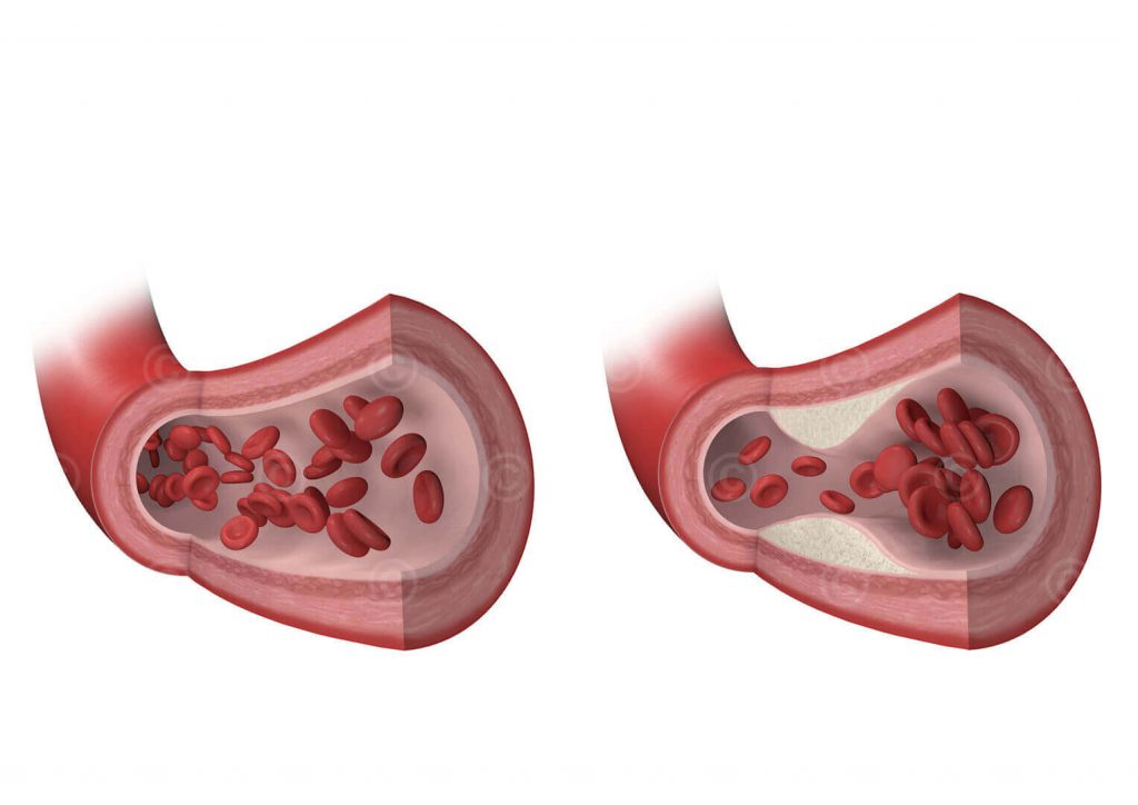 Arteriosklerose