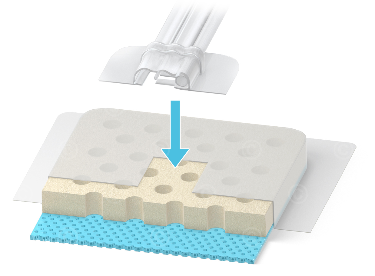 Design study of a wound dressing with an attachable port