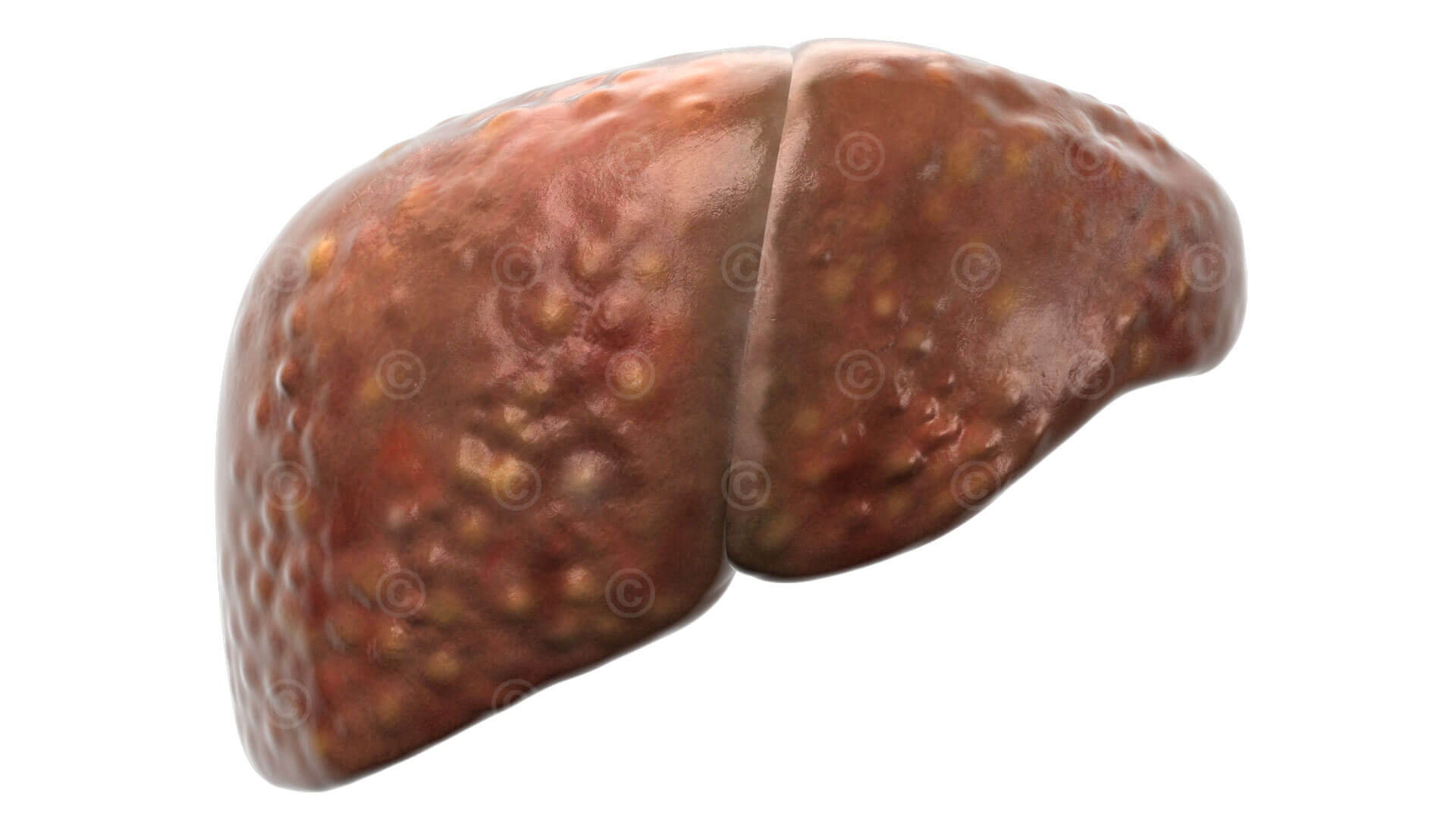 Liver fibrosis
