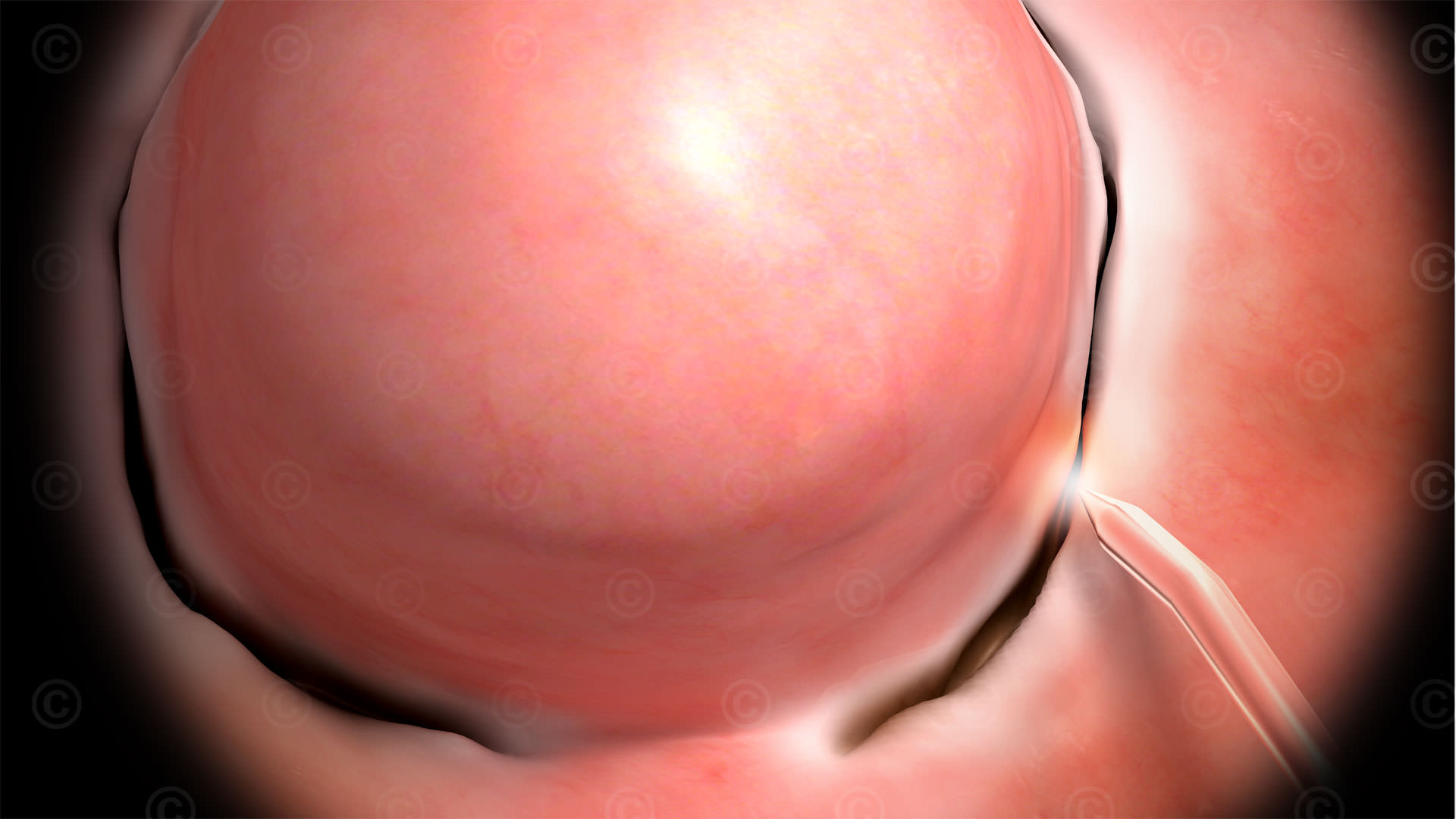 Myoma surgery