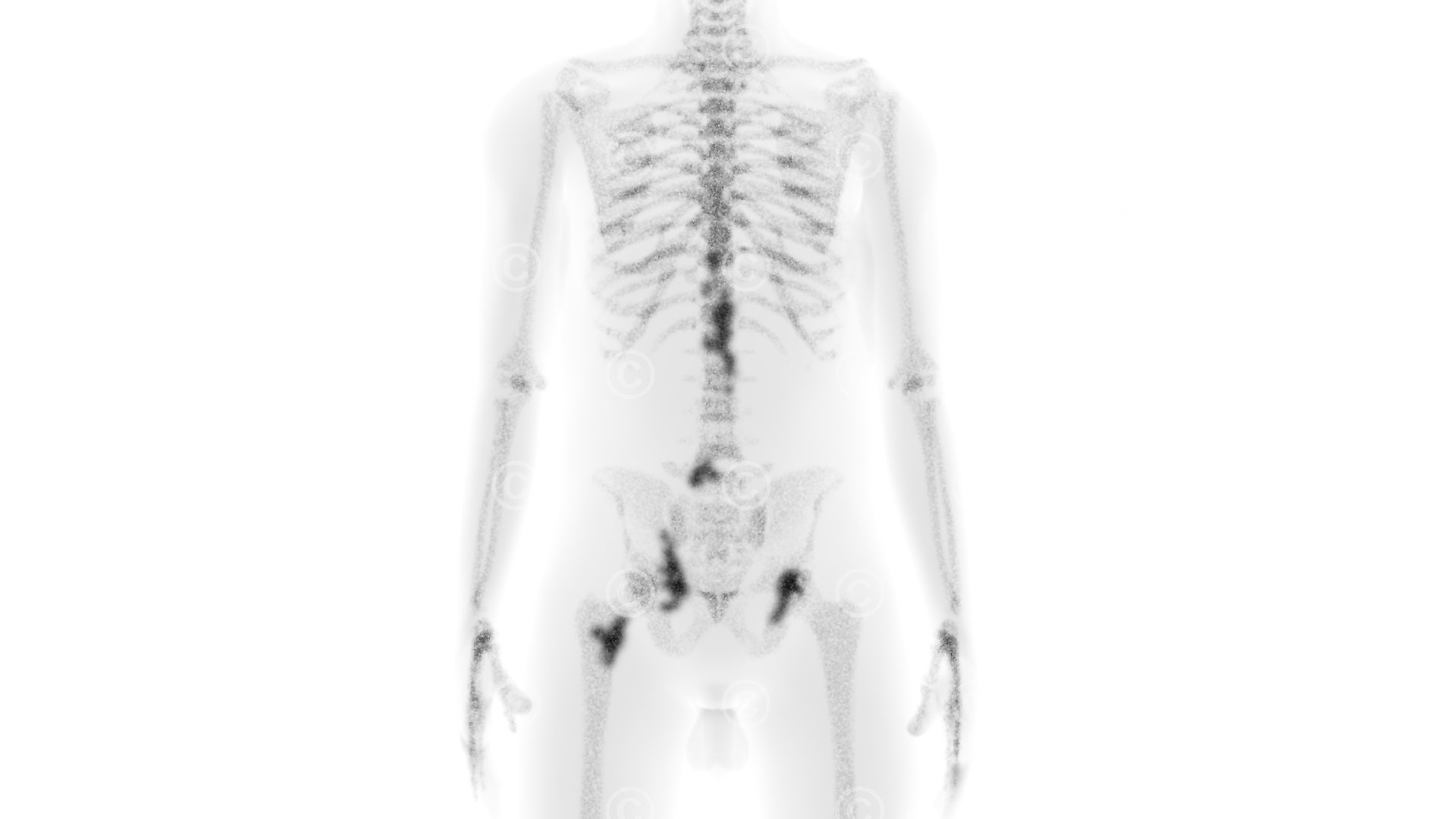 Illustration Skelettszintigraphie Illustration scintigraphy