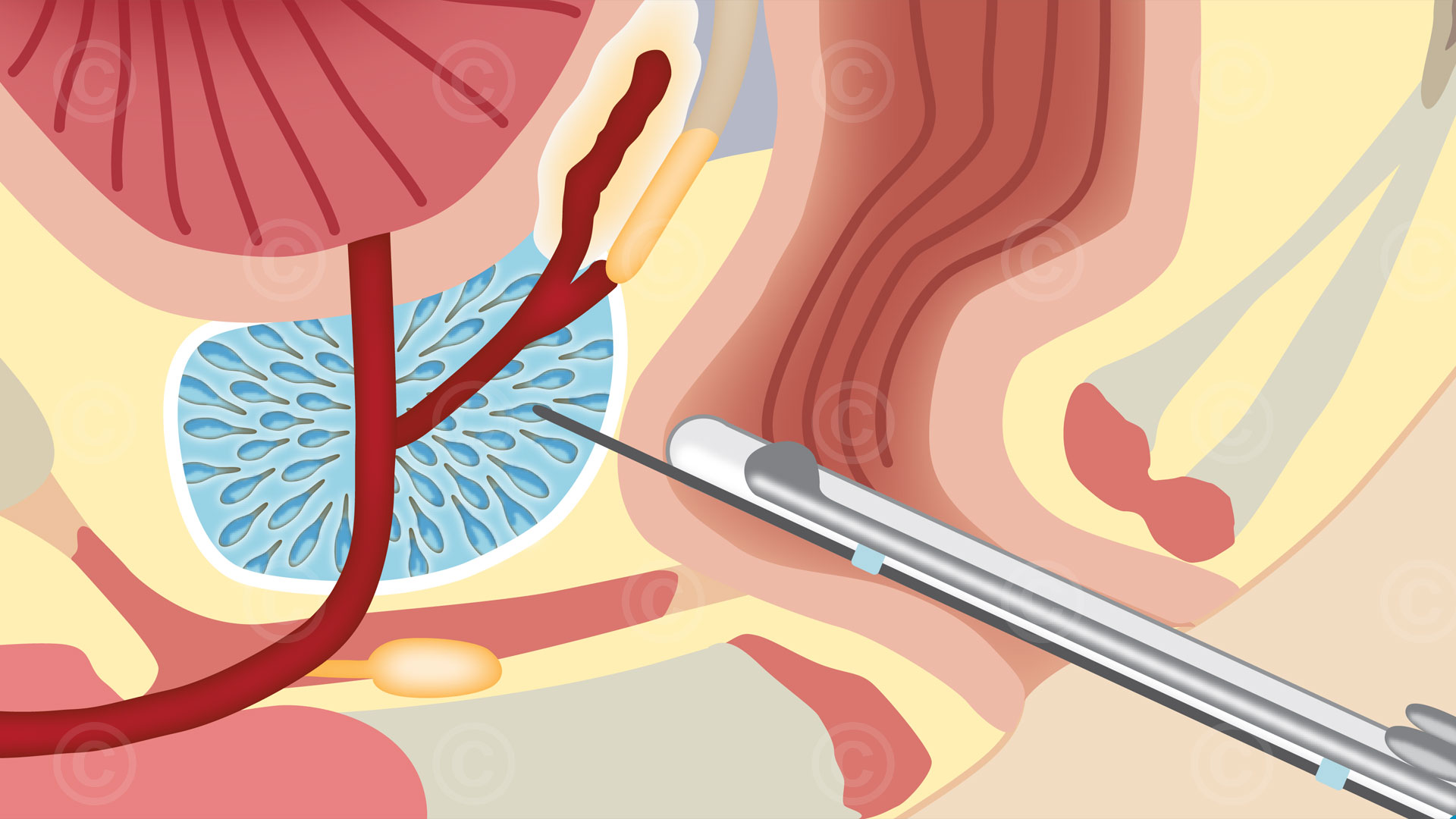 Illustration Biopsie Prostata Biopsy prostate gland
