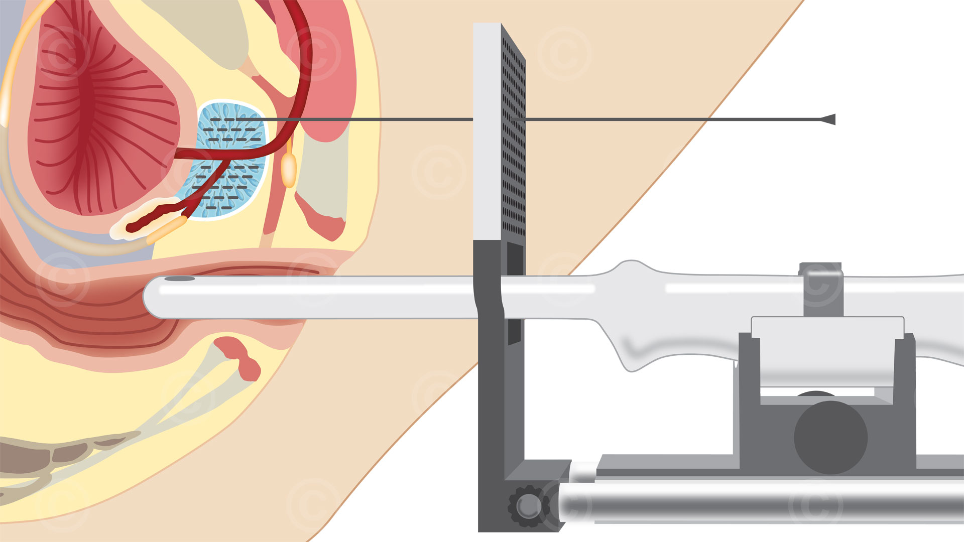 Illustration Brachytherapie Prostatkrebs Illustration brachytherapy prostate cancer