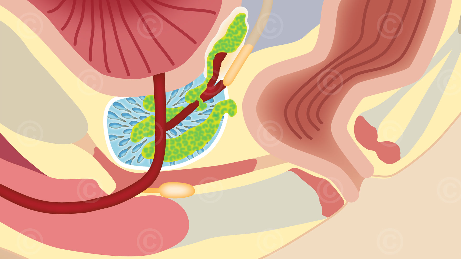 Locally advanced prostate carcinoma