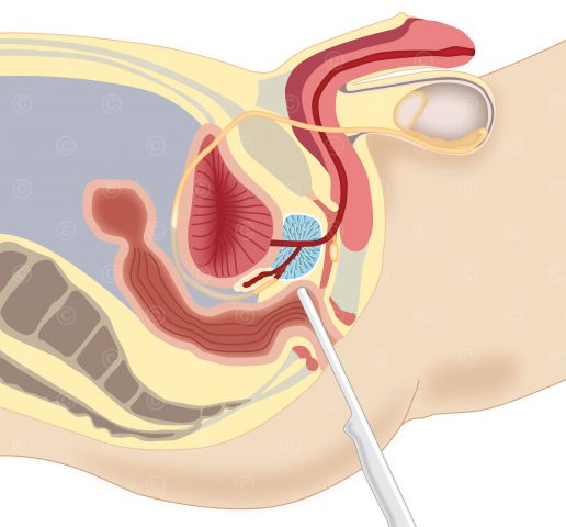 Transrektale Ultraschalluntersuchung Prostata