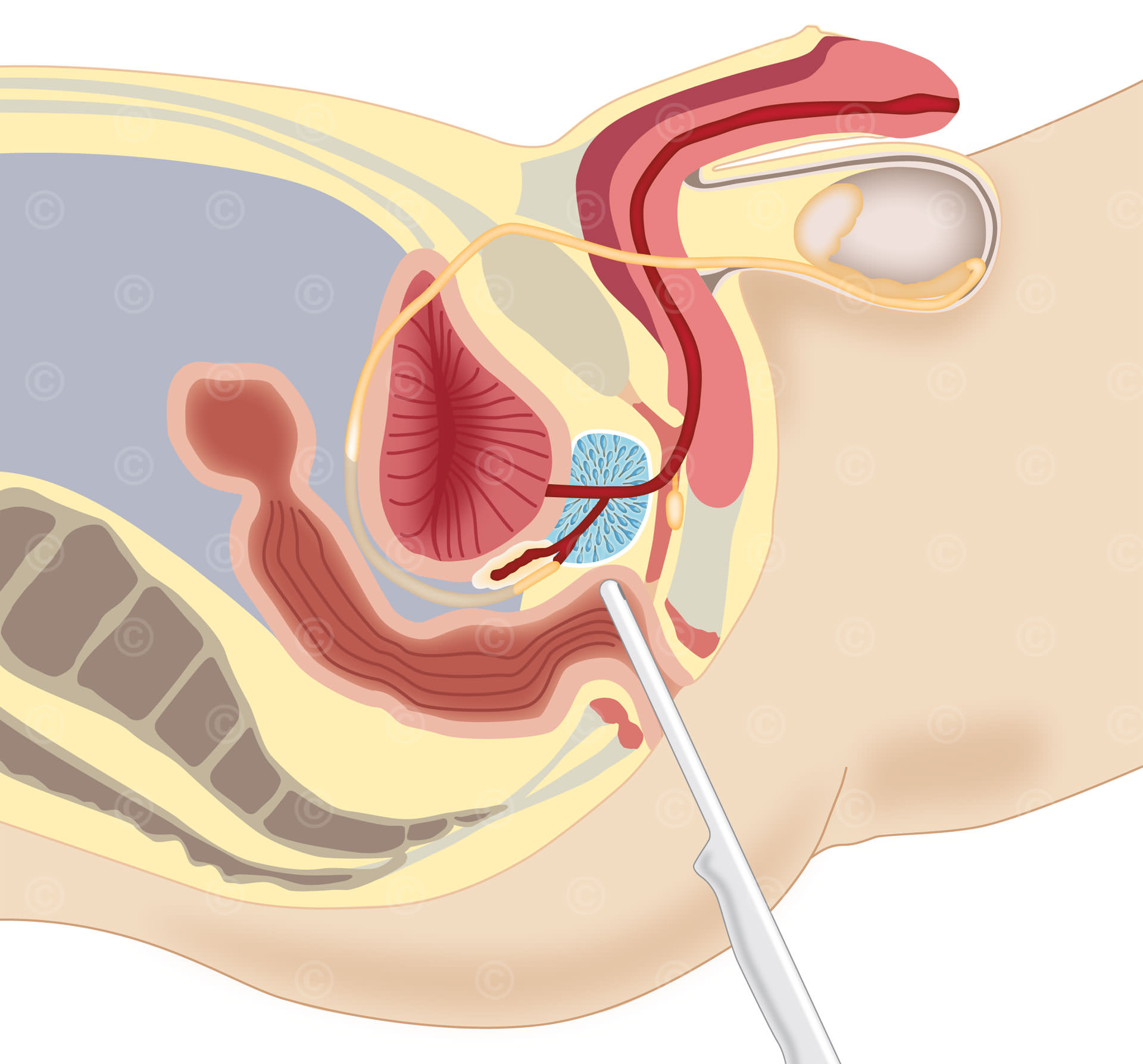 Transrektale Ultraschalluntersuchung Prostata 