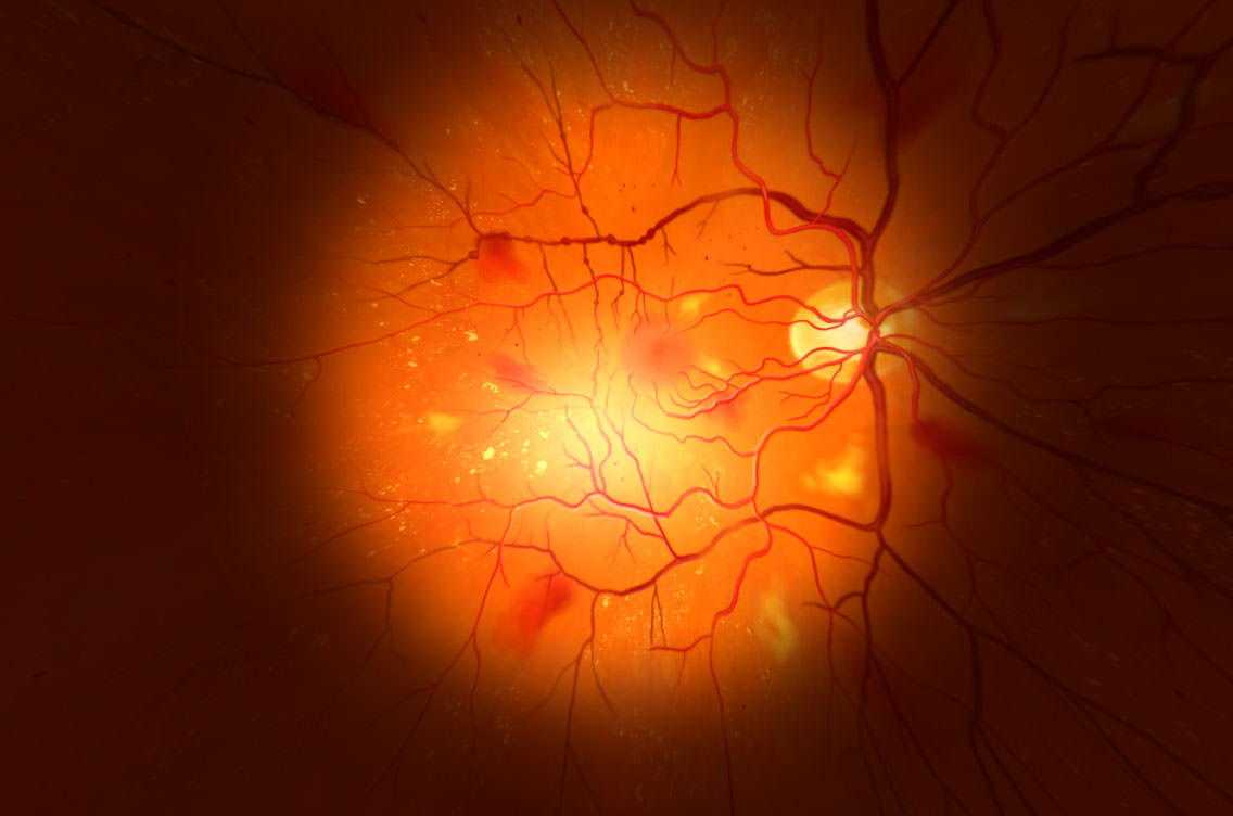 screenshots unity auge schwere Diabetische Retinopathie gross
