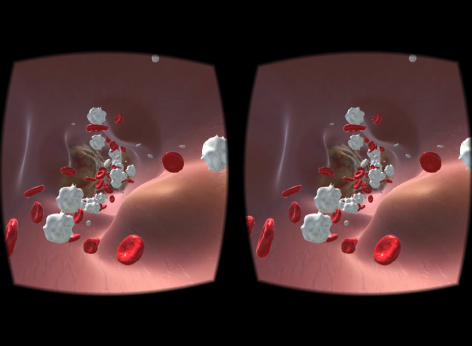 Stenose Gefäß Unity vr app diabetes verschluss
