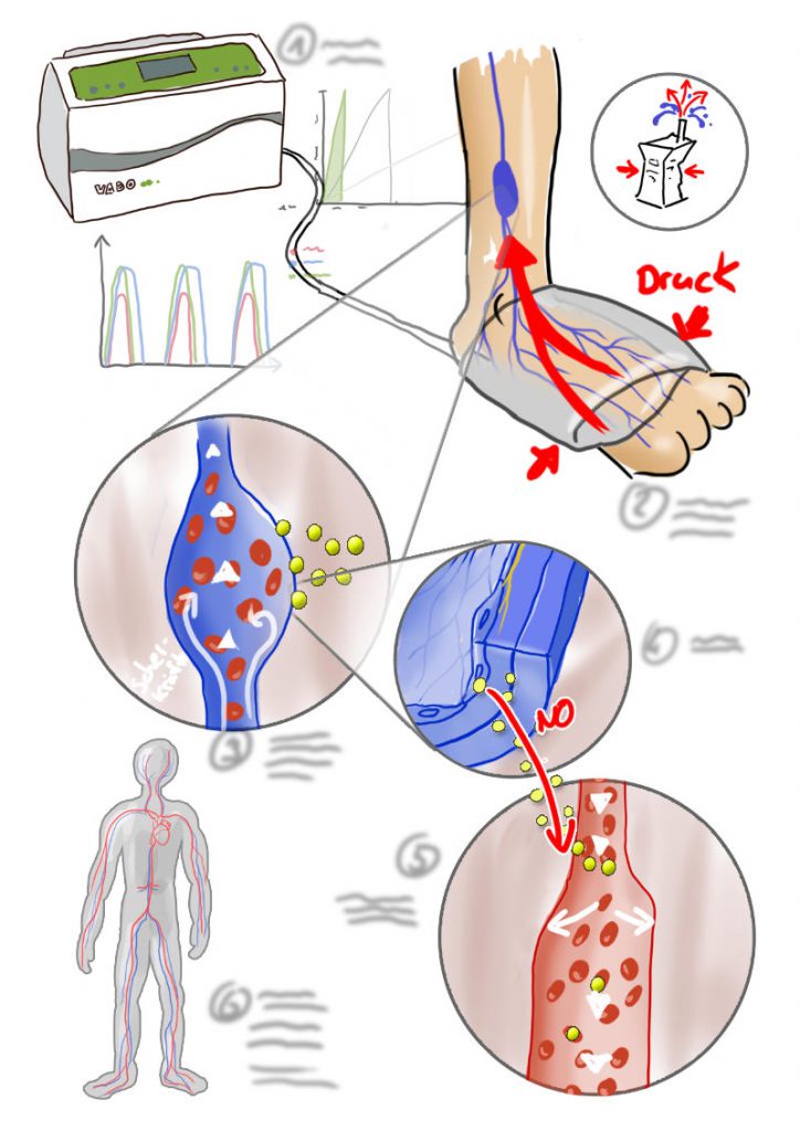 Infographic of compression therapy in vascular disease - MedicalGraphics