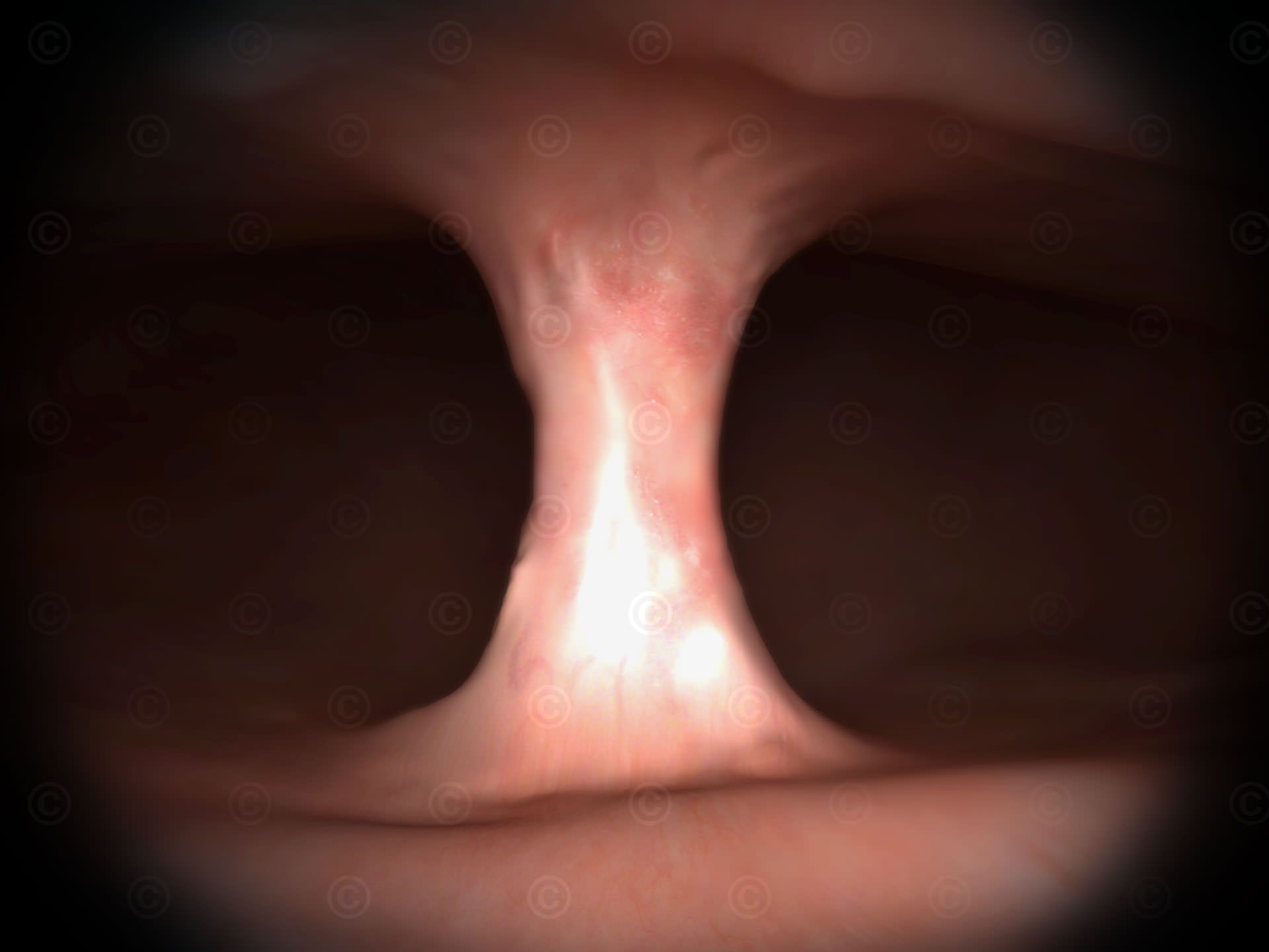 Septate uterus