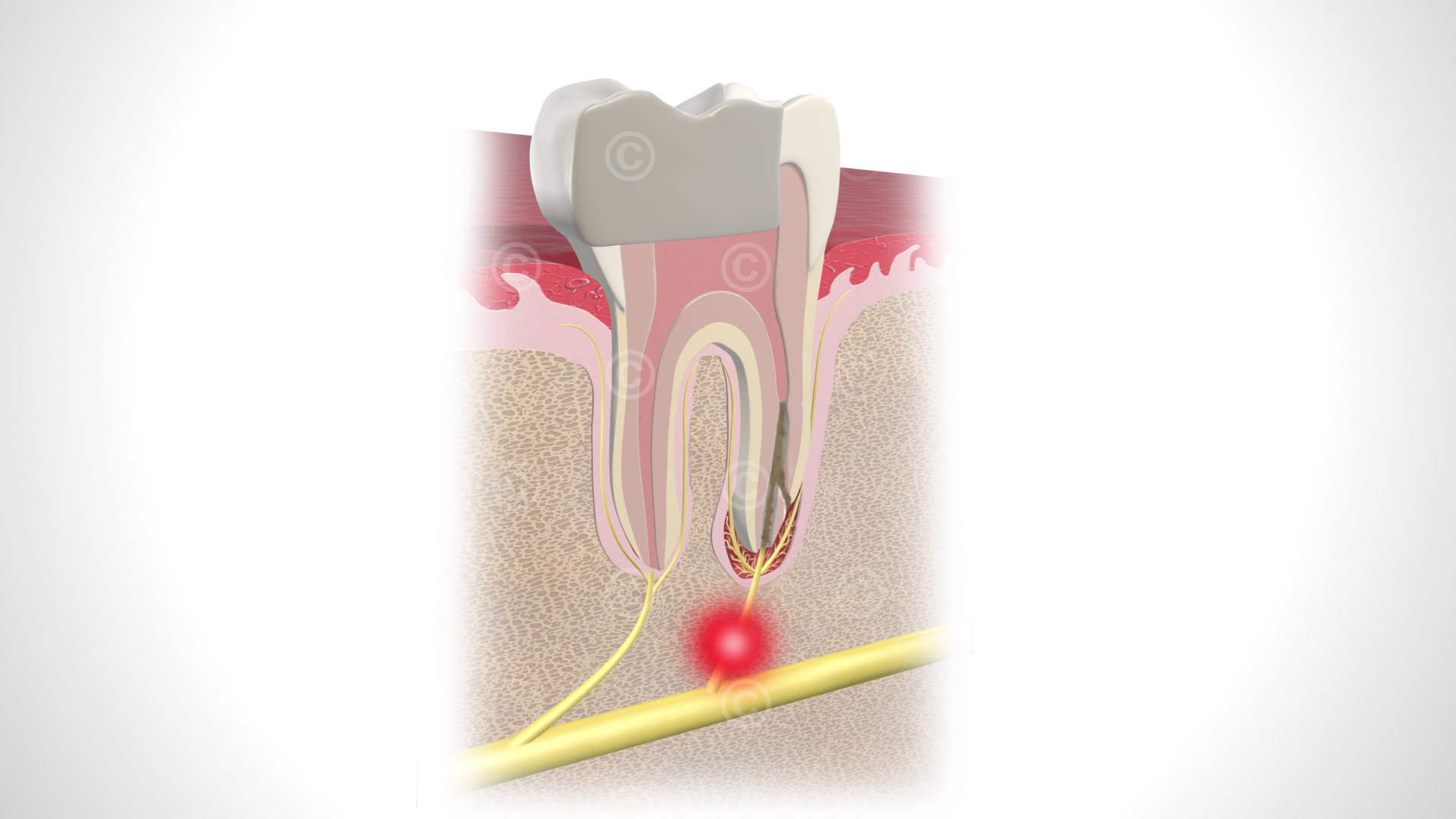 Pain caused by defective root filling of the tooth