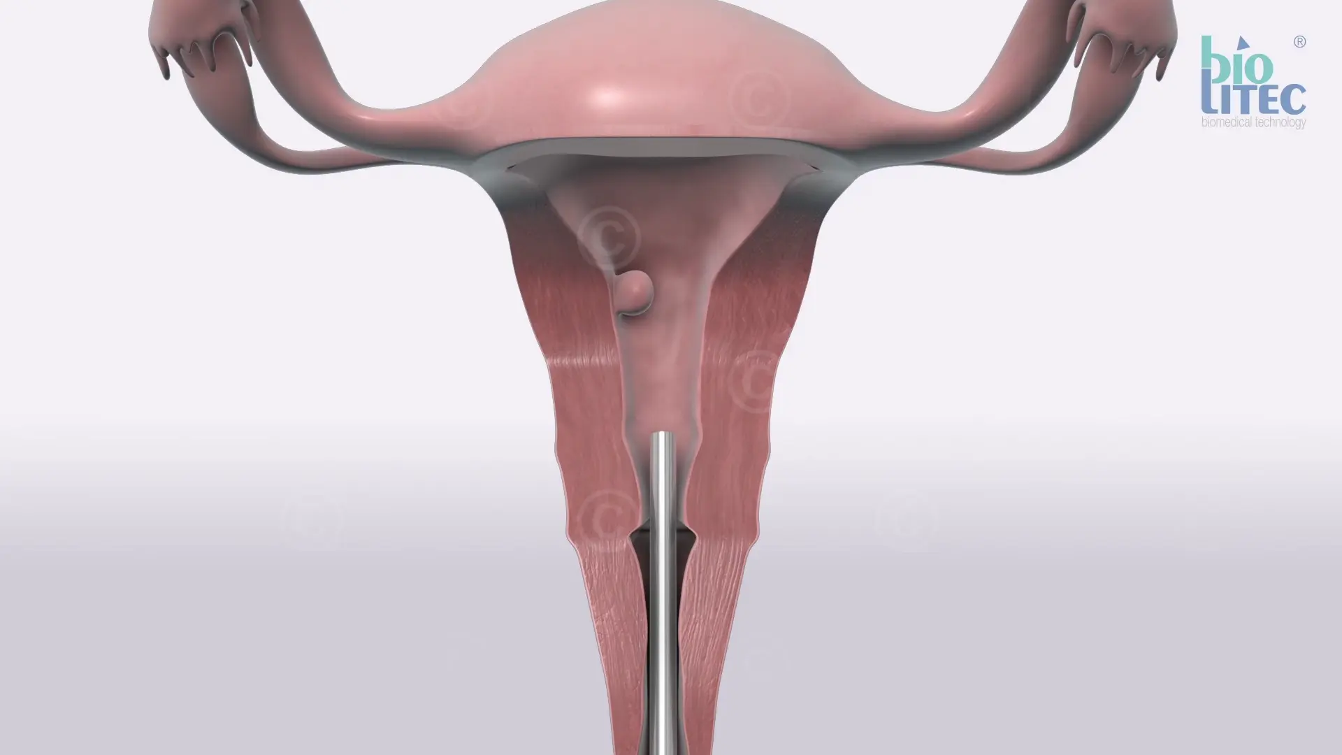 Minimally invasive myoma removal