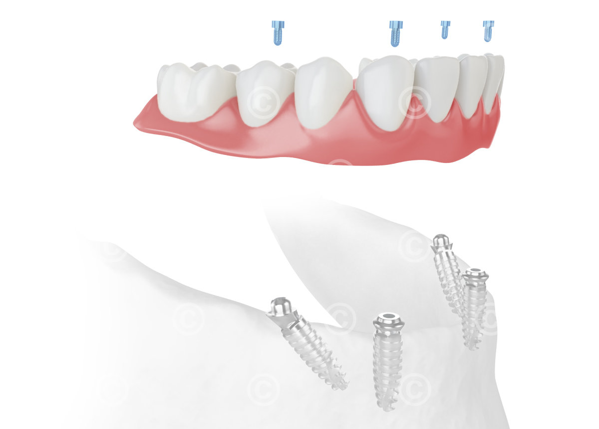 All-on-4 fitting dentures