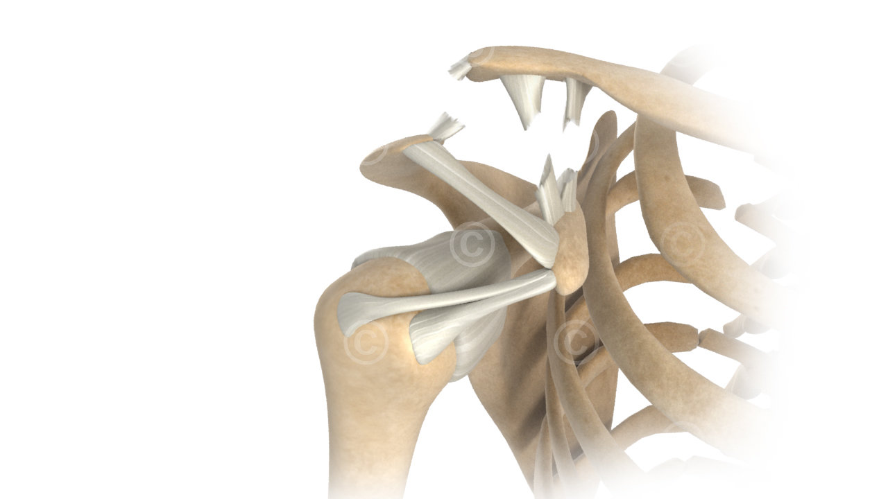 Shoulder joint injury - Tossy III