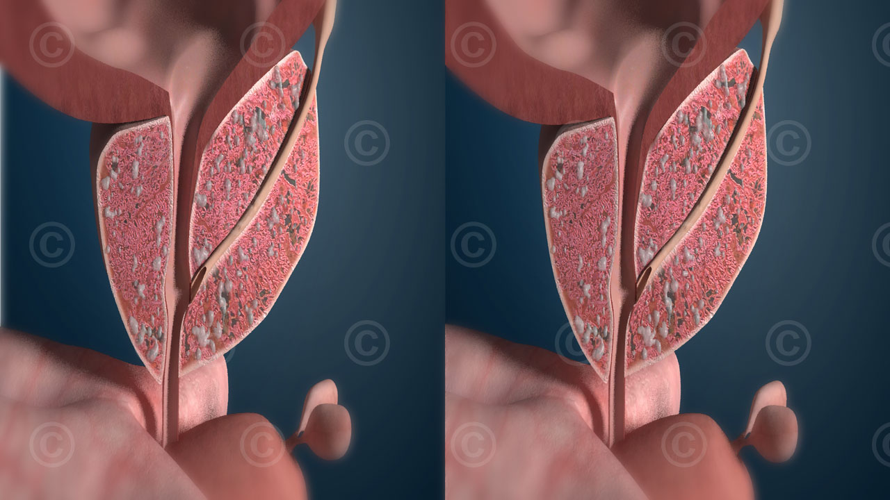 Stereoscopic 3D view of prostate with seminal vesicles