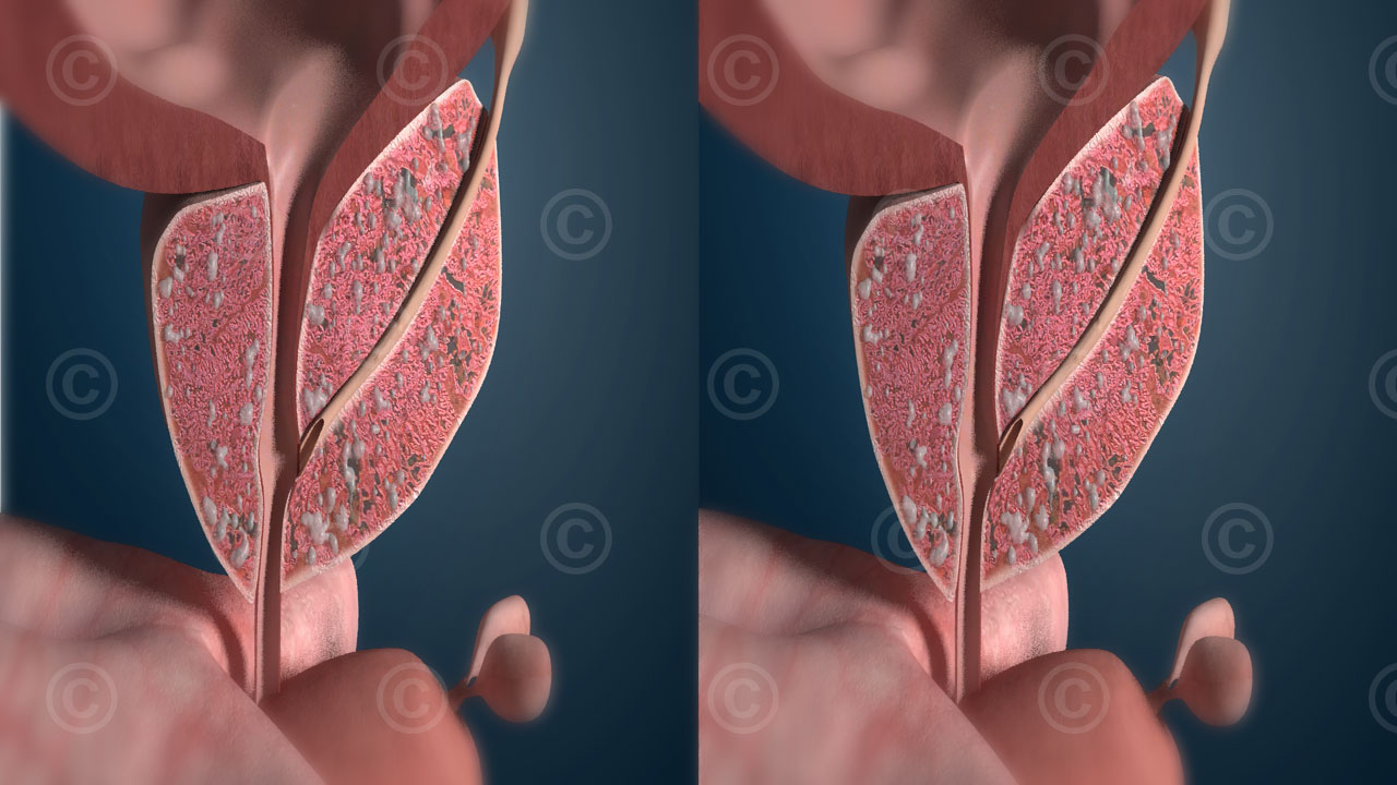 3d stereo prostata schnittansicht samenfluessigkeit