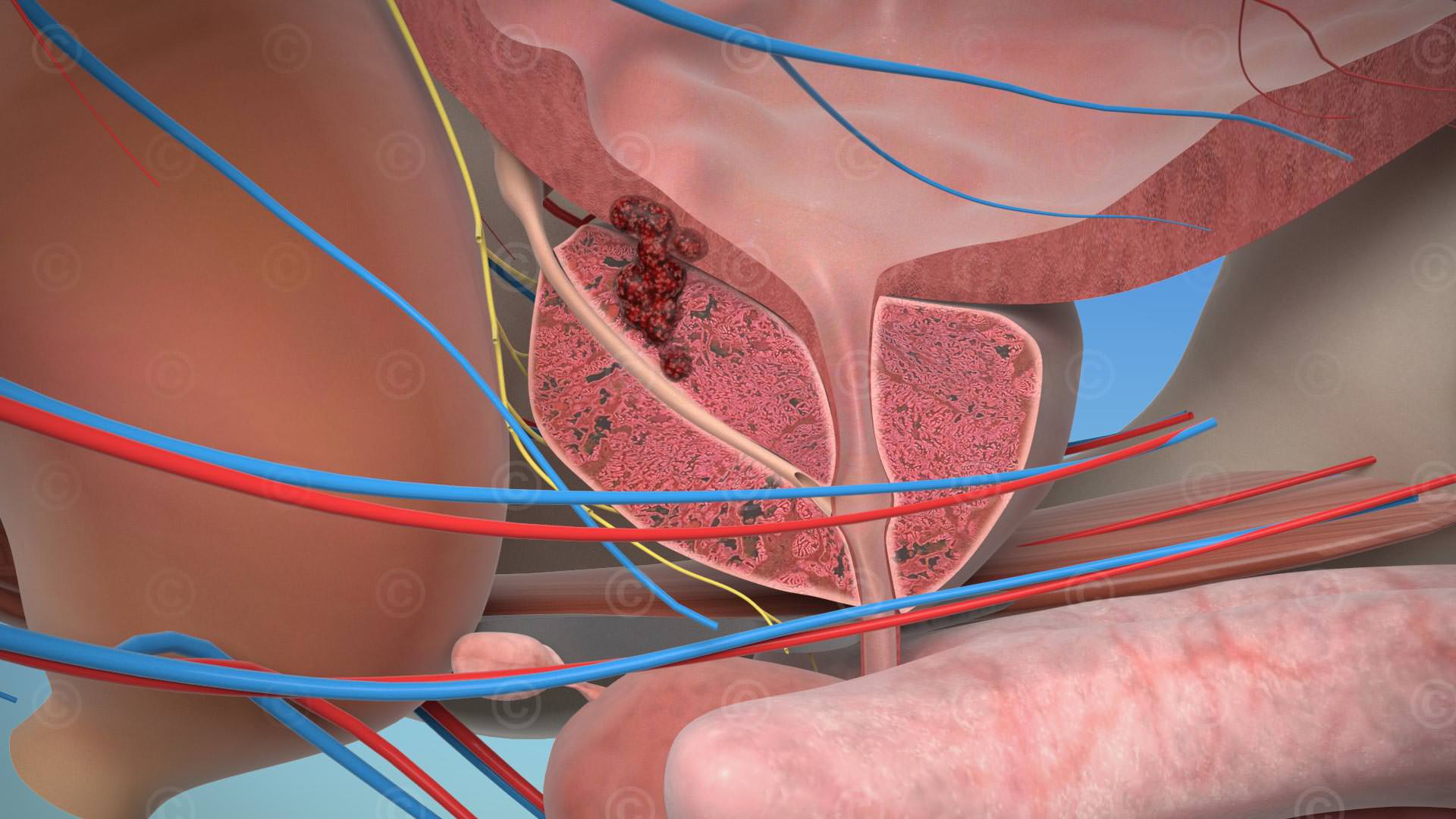 Stereoscopic 3D - Prostate cancer