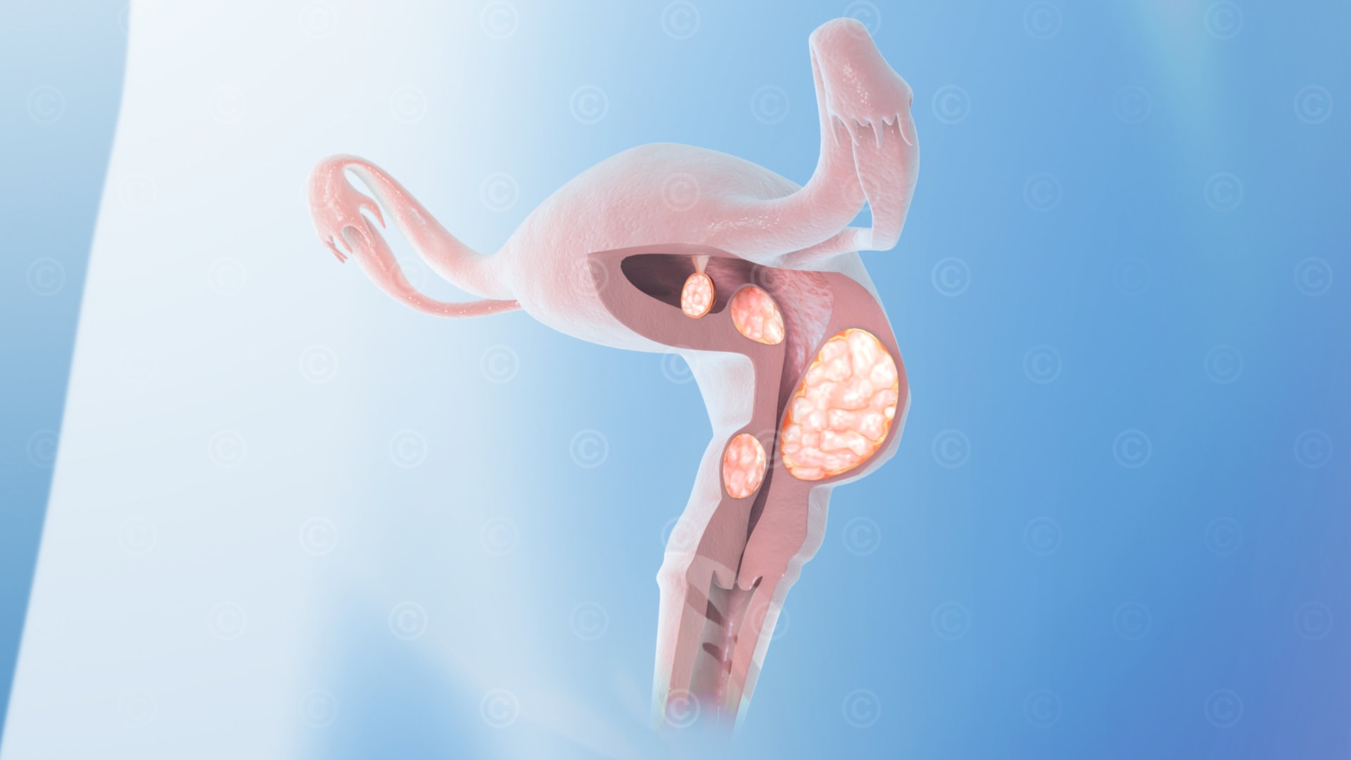 Uterine fibroids