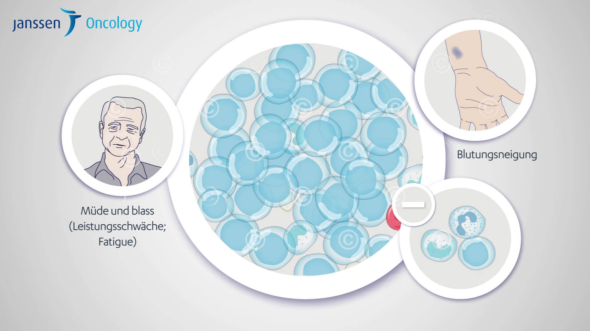 Symptome einer chronisch lymphatischen Leukämie Symptoms of chronic lymphocytic leukemia