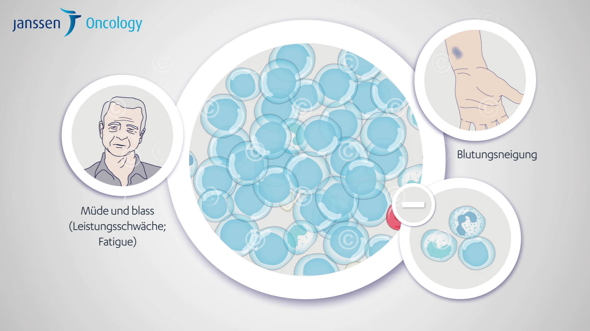 Symptoms of chronic lymphocytic leukemia