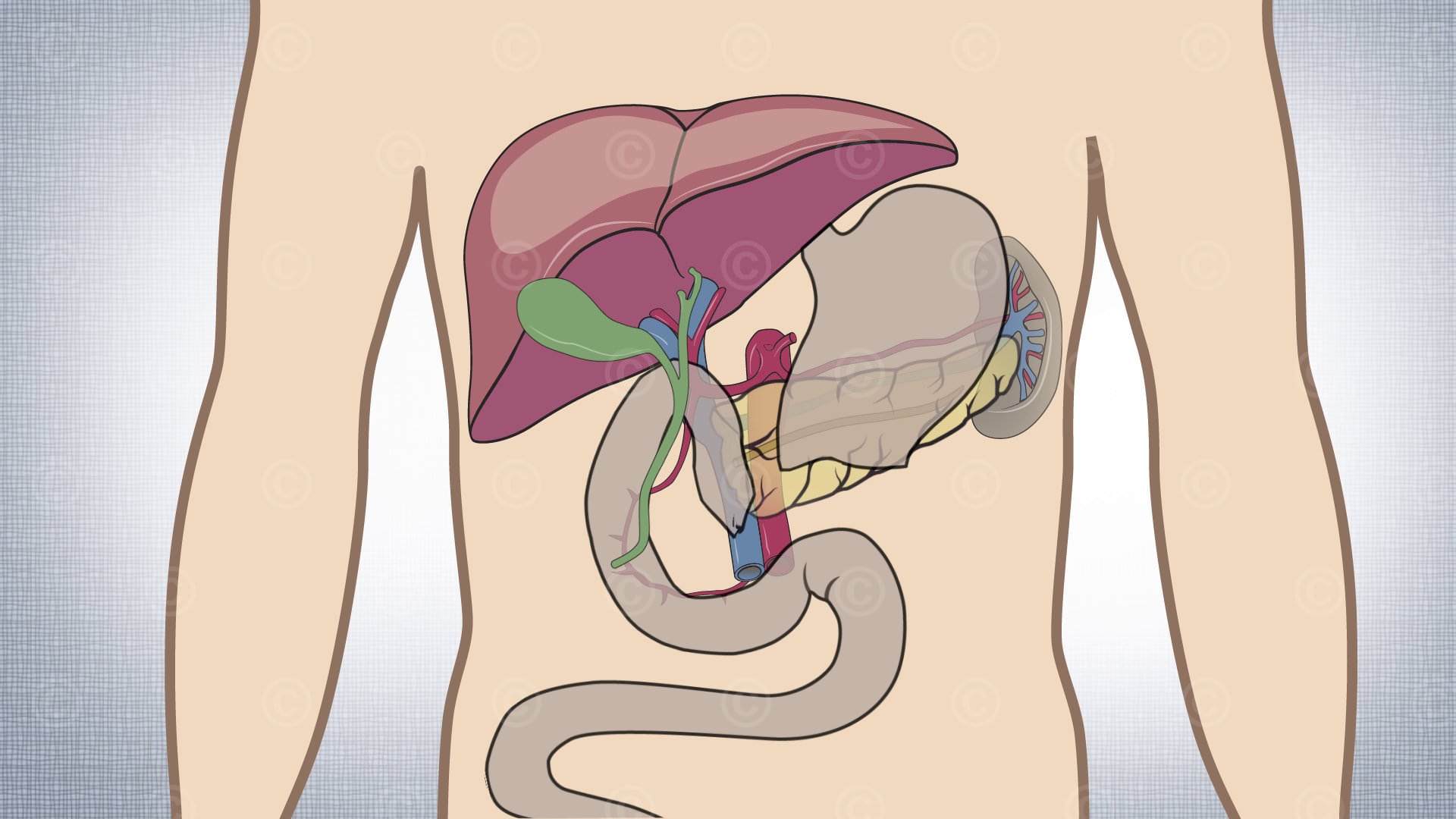 Pancreatic partial resection